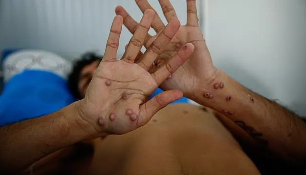 Una persona contagiada por el virus Mpox