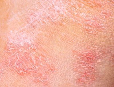 La dermatitis atópica se debe prevenir desde el nacimiento en niños con riesgo