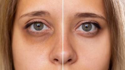 ¿Ojeras?: remedios y consejos para prevenirlas y aclararlas