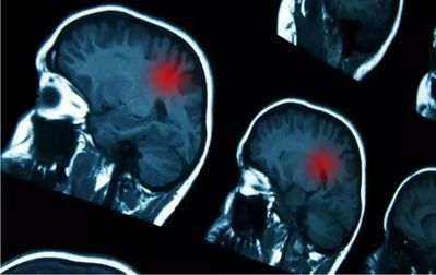 Prueban un nuevo tratamiento prometedor para el cáncer cerebral pediátrico